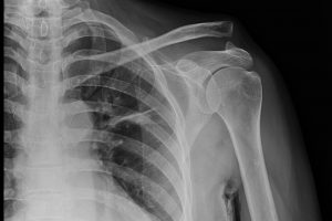 medicine, Separated shoulder, Collar bone