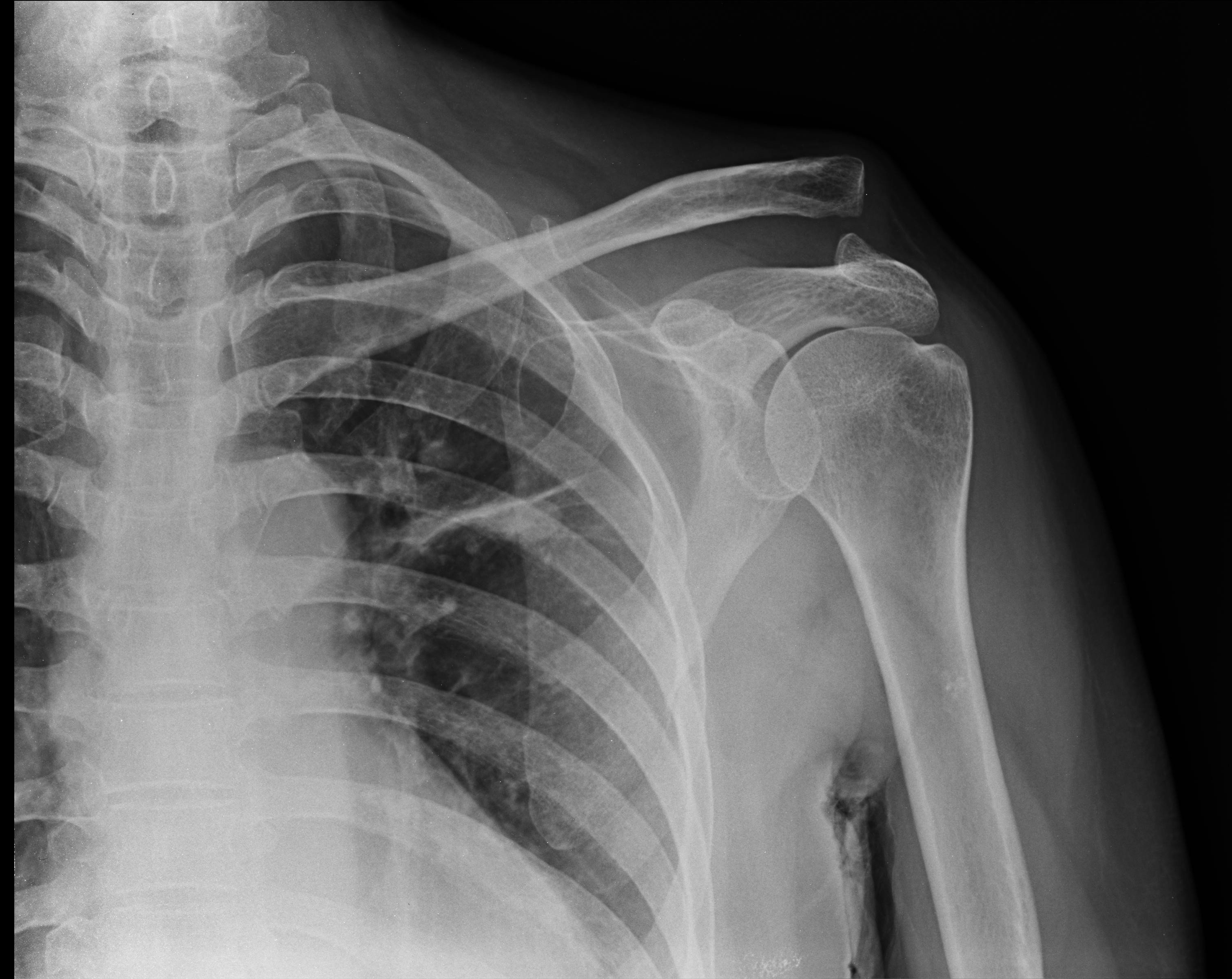 medicine, Separated shoulder, Collar bone Wallpaper